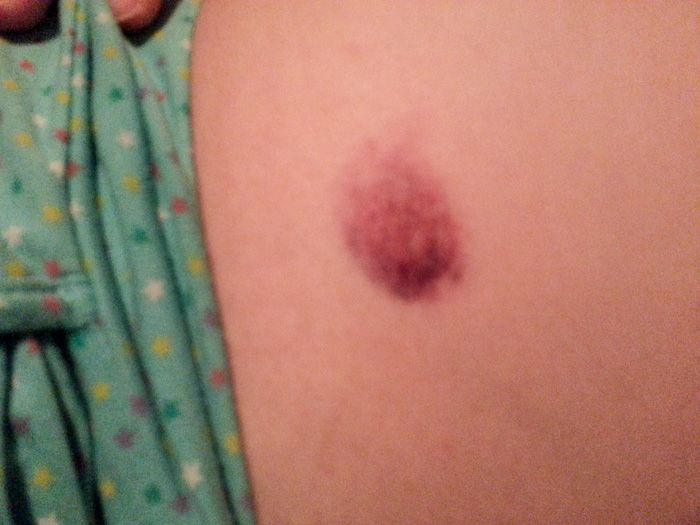 My first IVF war mark