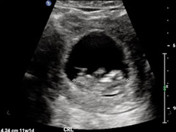 11 weeks with Olivia: We heard a heartbeat