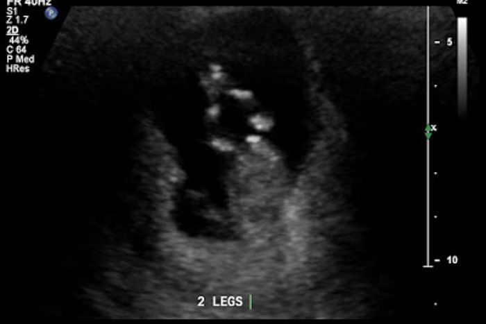 12 weeks with Olivia: Gas bubble or baby?