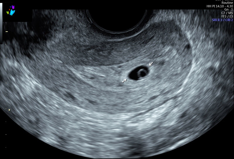 5 Weeks: First OB Ultrasound