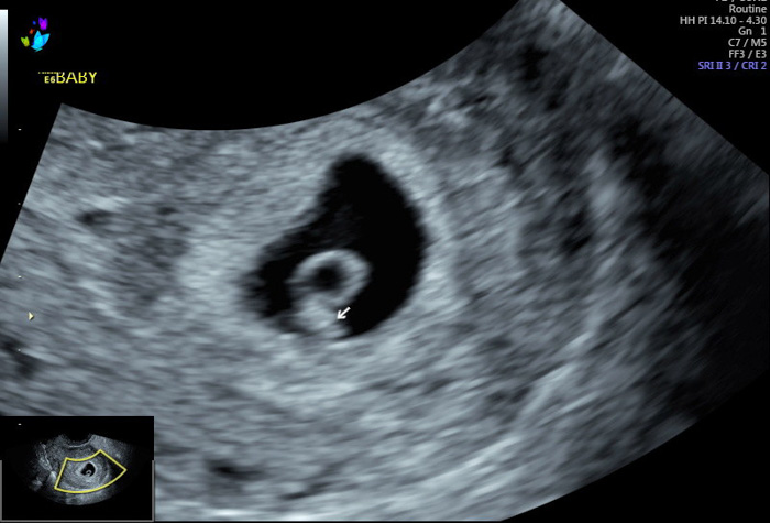 6w4d Heartbeat