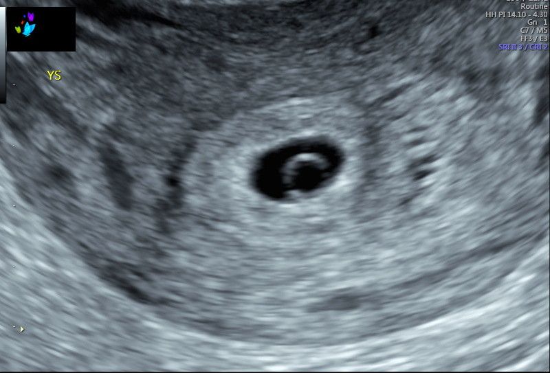 5 Weeks: First OB Ultrasound