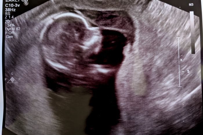 14 Weeks with Emelia: Hello Second Trimester!