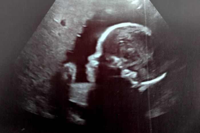 26 weeks with Emelia: It’s time for more ultrasounds, but at least I get to see how fluffy her cheeks get