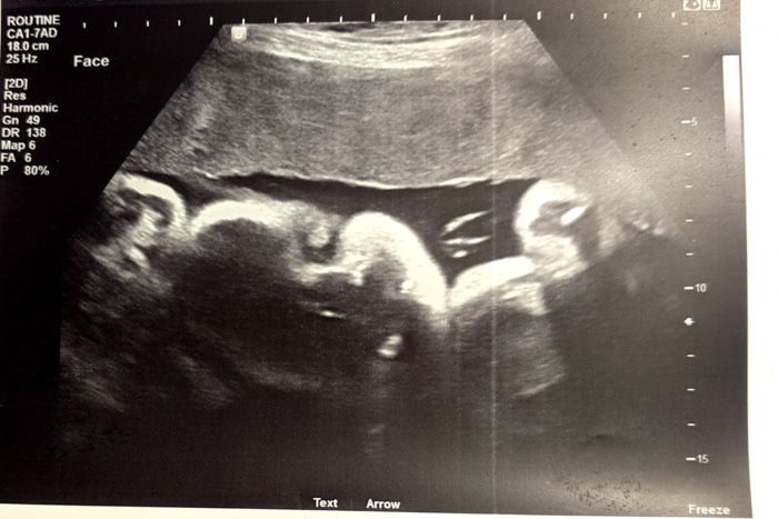 31 Weeks with Emelia: Chugging along. Not sleeping. Still peeing.